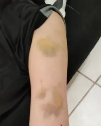 Aluno com autismo é agredido por professor e fica com hematomas