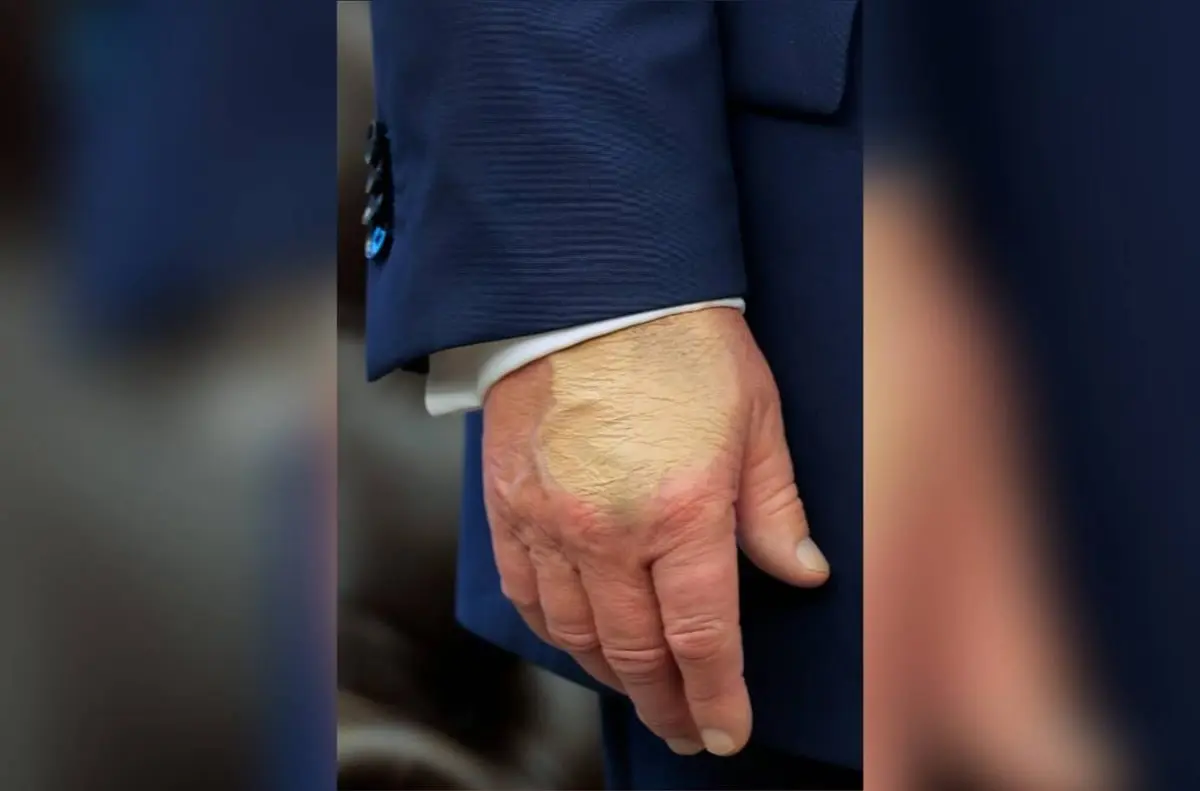 Donald Trump tem mão maquiada após diagnóstico de doença venosa; entenda o quadro
