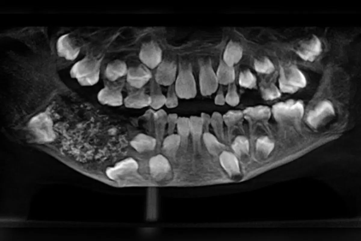 Menino de 7 anos tem 526 dentes arrancados em cirurgia; entenda (Foto: Divulgação/Saveetha Dental College and Hospitals)