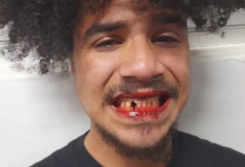 Seguranças da CPTM espancam jovem na Zona Leste de São Paulo; vítima perde dente e acusa racismo