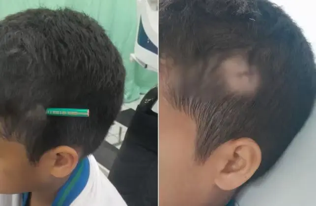 Estudante de 9 anos ficou com um lápis fincado na cabeça após ser agredido por um colega de classe em Praia Grande. Foto: Arquivo pessoal