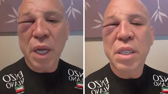 Com o rosto deformado, Wanderlei acusa equipe de Popó: 'fui covardemente agredido' (Foto: Reprodução/Redes Sociais)