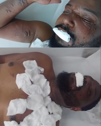Homem tem rosto e corpo queimados por mulher 