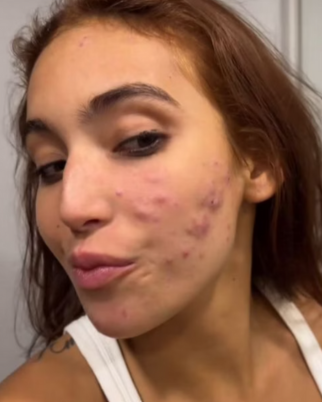 Vanessa Lopes mostrando acnes em foto