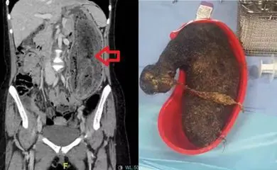 Foto: Journal of Surgical Case Reports