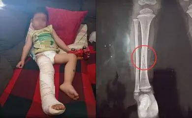 Briga em creche termina com criança de 2 anos com a perna quebrada; entenda