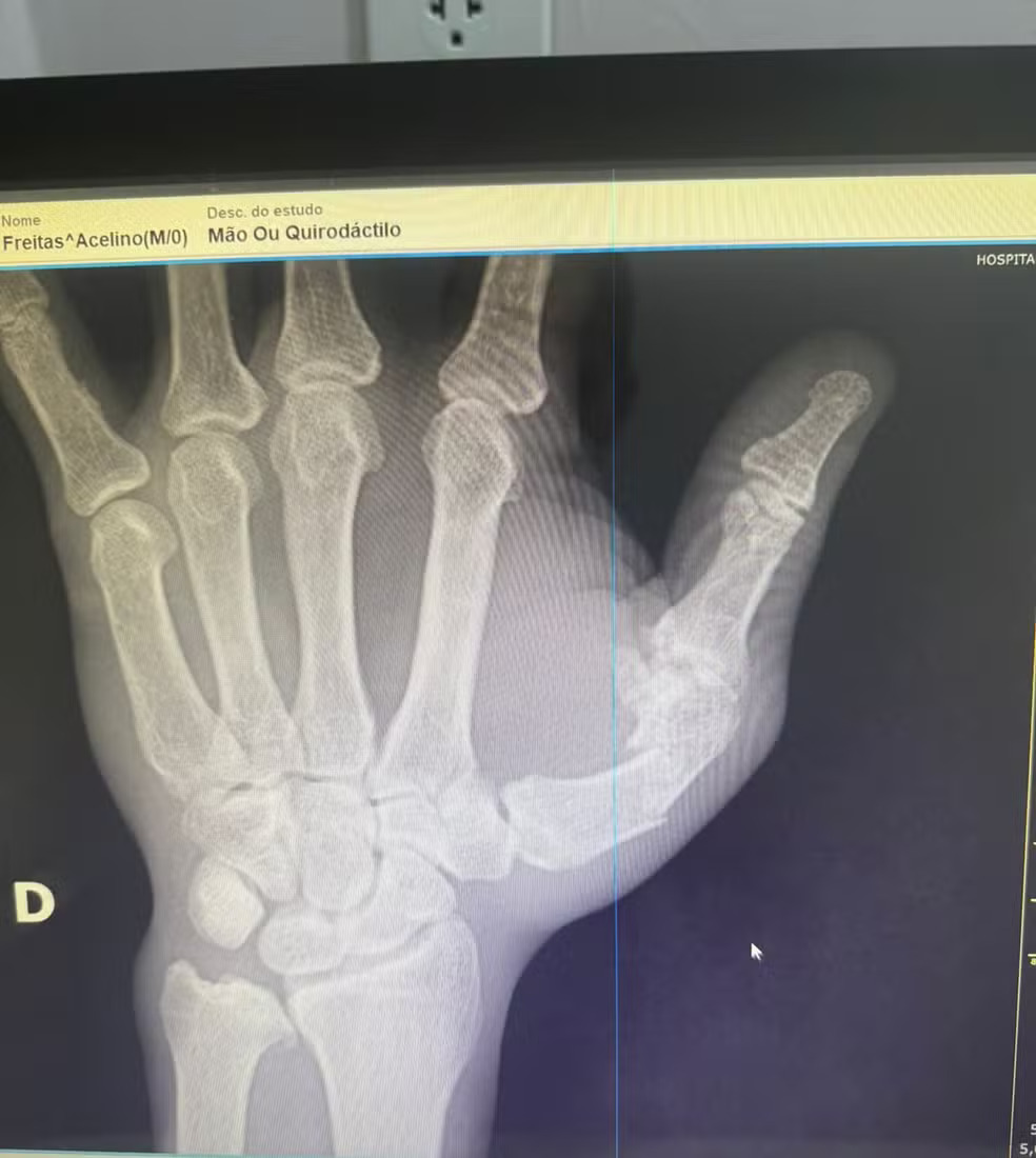 O lutador passou por cirurgia após uma confusão que ocorreu durante uma luta no último sábado. O evento que terminou em pancadaria resultou na mão quebrada. 