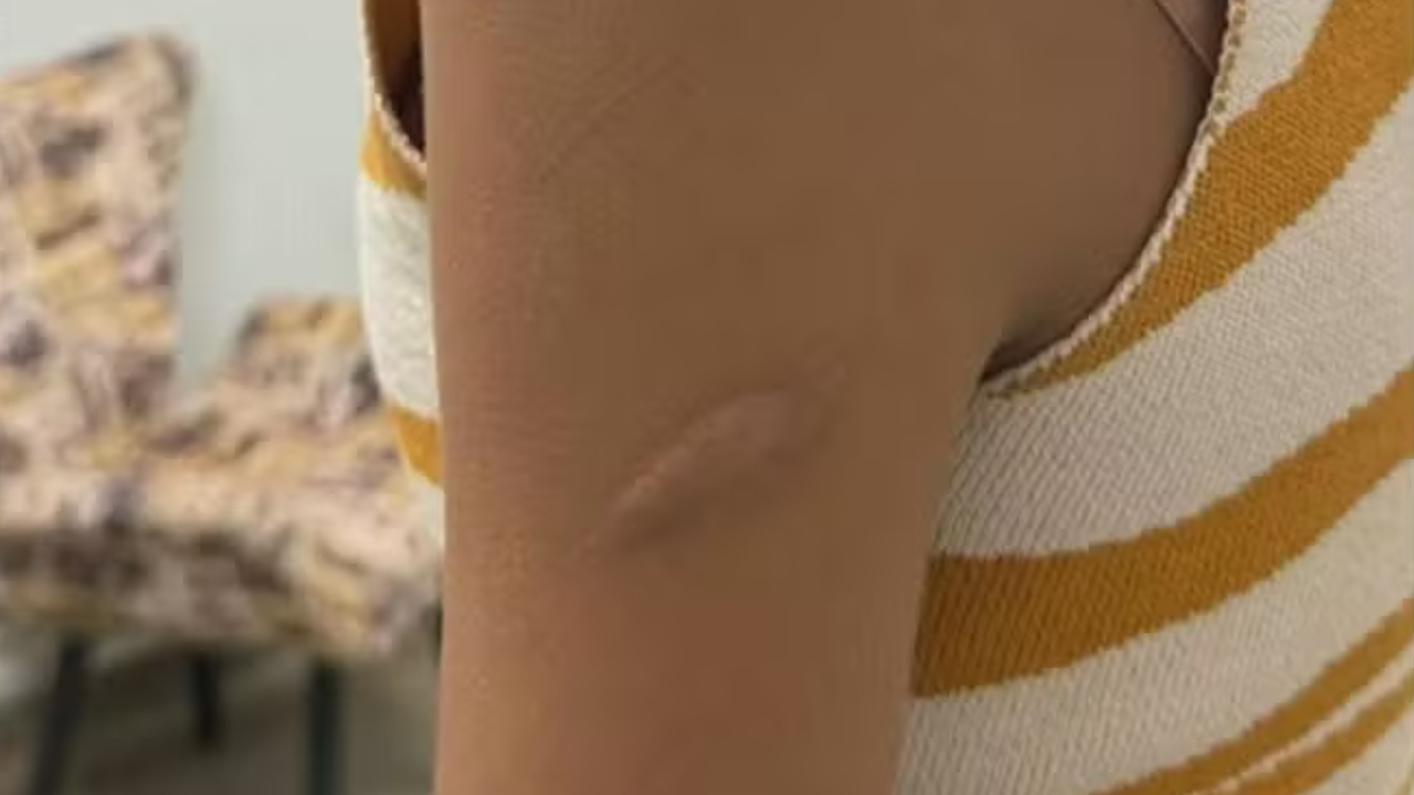 Marcas no braço de uma das vítimas mostram sequelas das agressões cometidas pelo pai de santo.