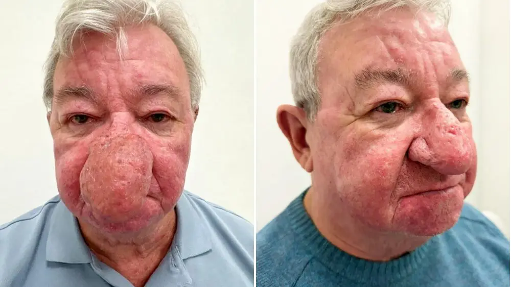 O escocês Gerard McAliece, de 68 anos, passou por uma cirurgia reconstrutiva após seu nariz crescer tanto que impedia até mesmo de beijar a esposa. Divulgação