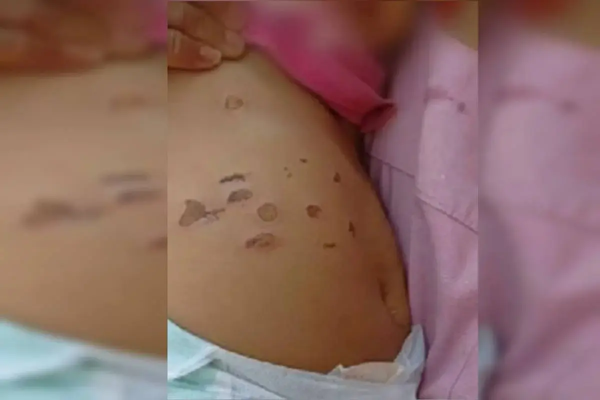 Bebê de 10 meses é queimada por cigarros na barriga e nas pernas; padrasto é suspeito das agressões