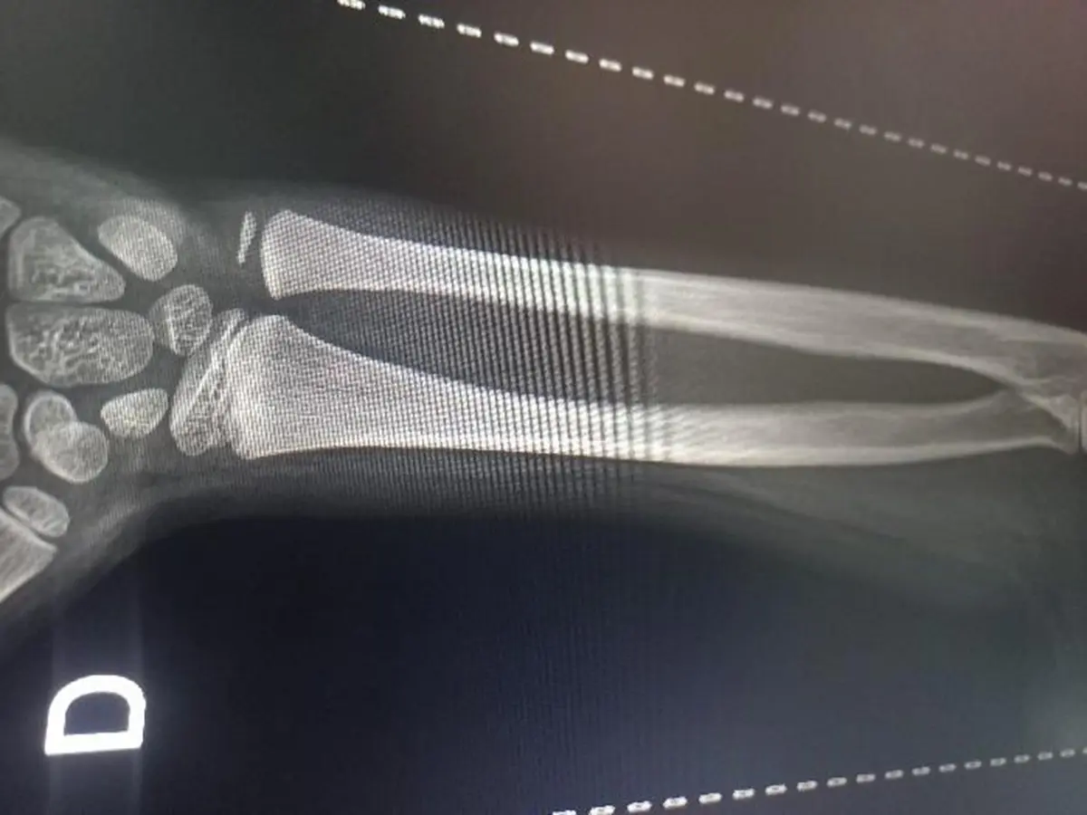 Mãe quebra o punho do próprio filho e acaba presa