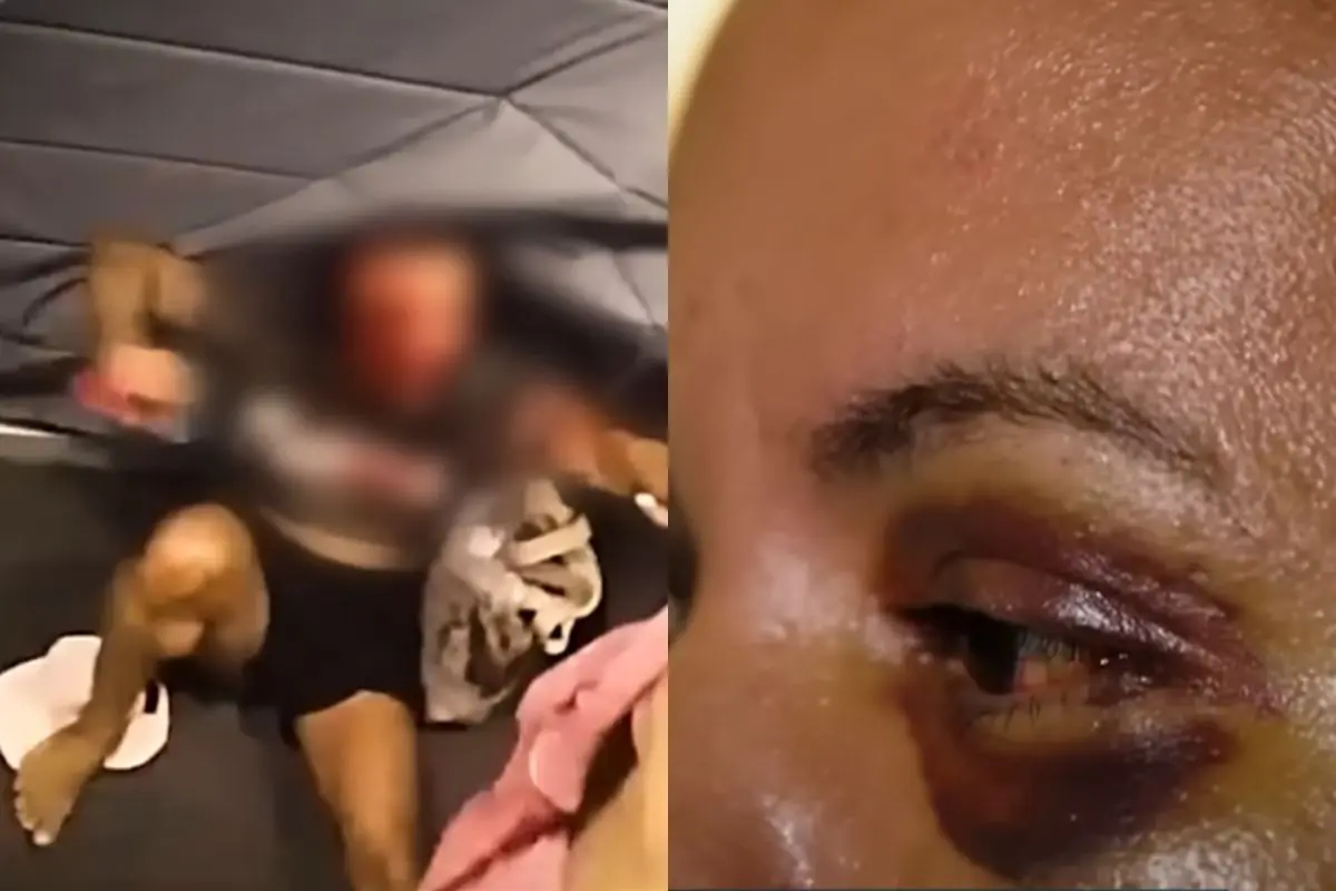 Após cirurgia para reconstruir a face, veja como está mulher que levou 61 socos do namorado em elevador