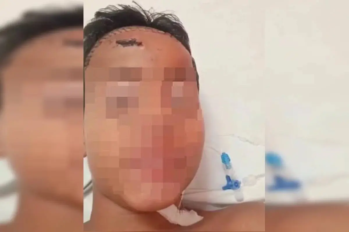 Menino espancado por gangue no lugar do irmão recebe alta