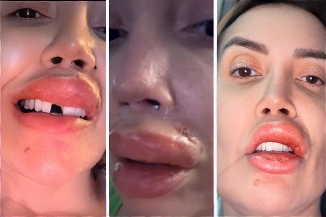 Paula mostra como ficou seu rosto após procedimento estético || Reprodução: Redes Sociais 