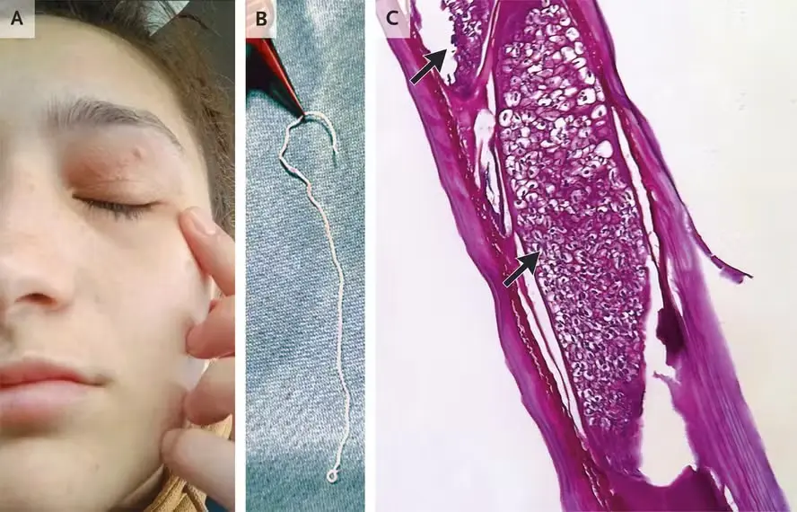 Nas imagens, é possível visualizar a lesão deixada pelo parasita sobre o olho da paciente (A), o verme depois de ser retirado cirurgicamente (B) e as microfilárias observadas no interior do Dirofilaria repens (C) — Foto: Ruxandra Moroti Constantinescu; Gabriela Andreea Dumitru
