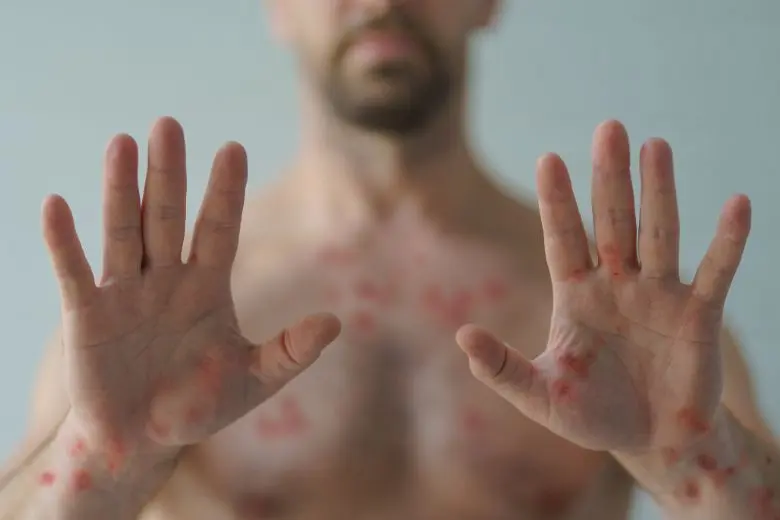Mpox pode afetar fertilidade masculina, aponta estudo