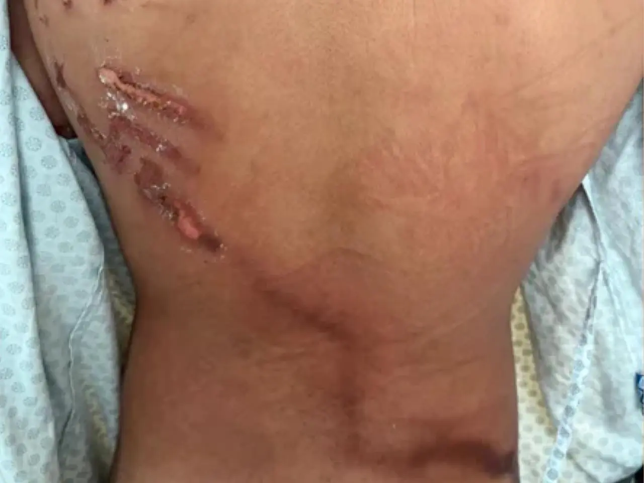 Jovem atingido por raio em manifestação de Nikolas Ferreira relata pavor e paralisia || Reprodução: Material Metrópoles 