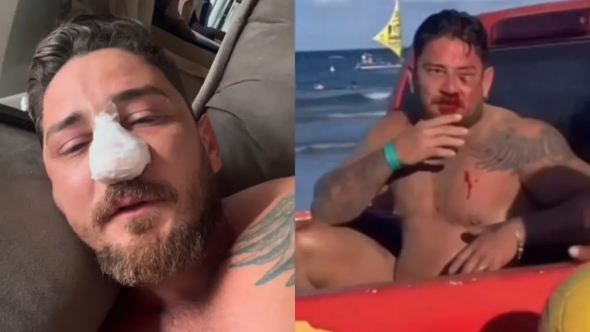 Turista agredido em Porto de Galinhas passa por cirurgia após fraturas - Foto: reprodução/redes sociais