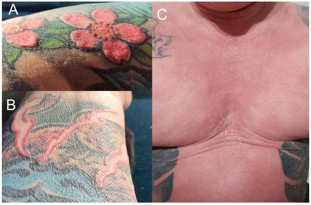 As inflamações da pele do paciente eram bem evidentes nas áreas com presença de tinta vermelha, que foi posteriormente removida através de cirurgias  (Foto: Magdalena Łyko/Clinics and Practice)