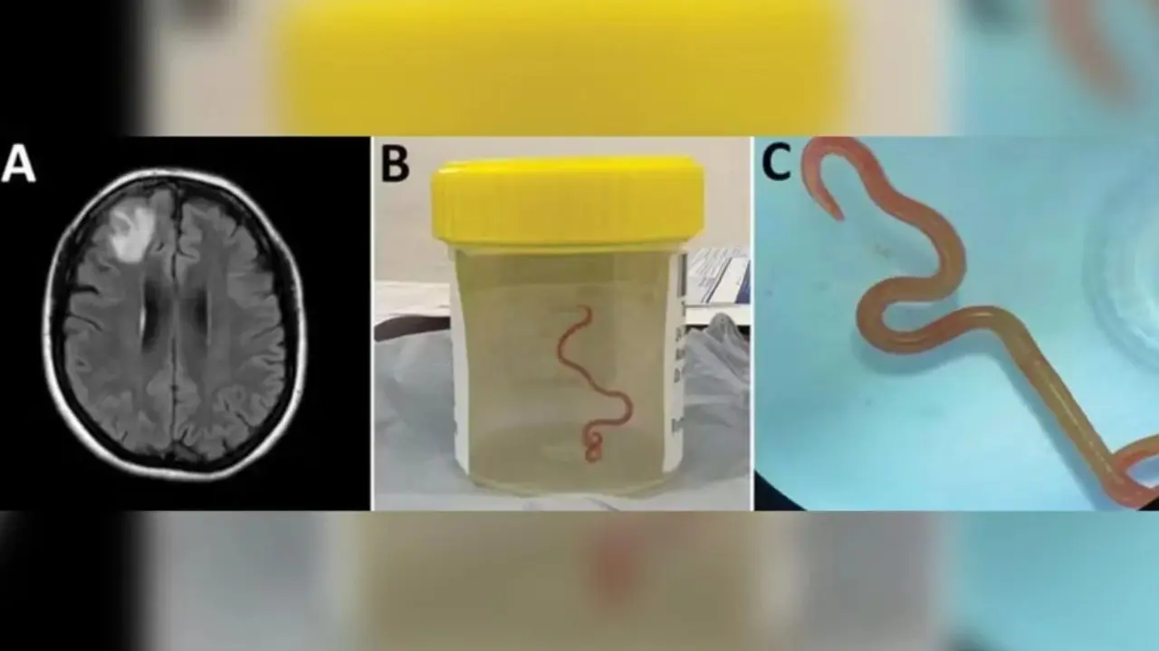 Verme parasita (Reprodução/ U.S. Centers for Diesease Control and Preservation)