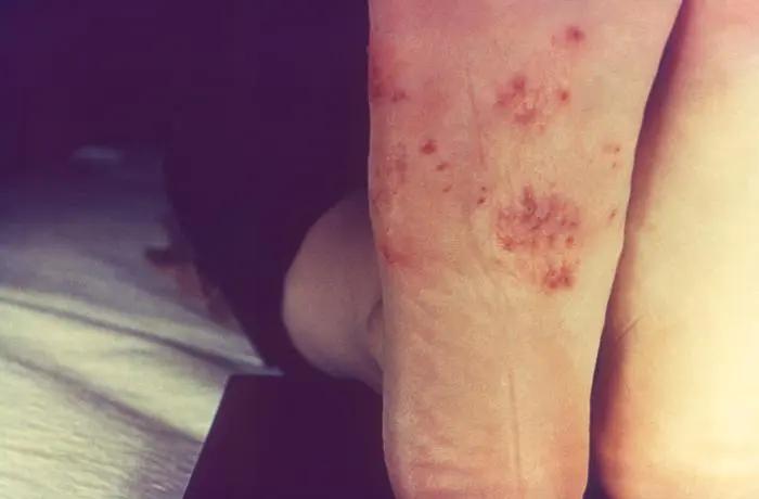 Lesões na região genital e virilha podem indicar infecção pelo fungo TMVII, que exige diagnóstico médico e tratamento adequado. Foto: Divulgação.