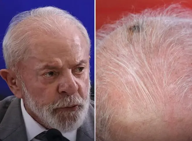 Lula aparece em cerimônia com marca na cabeça - Foto: Reprodução/Redes Sociais 