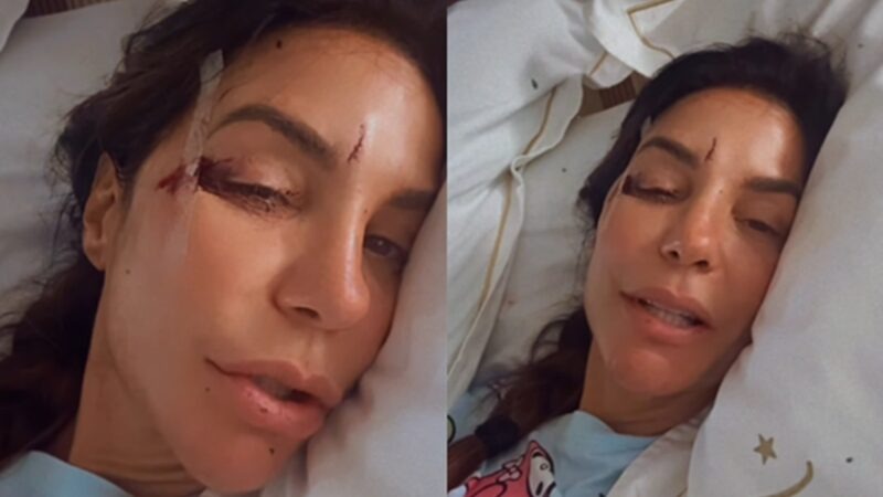 Ivete aparece com rosto machucado e tranquiliza fãs: 'cai com tudo'