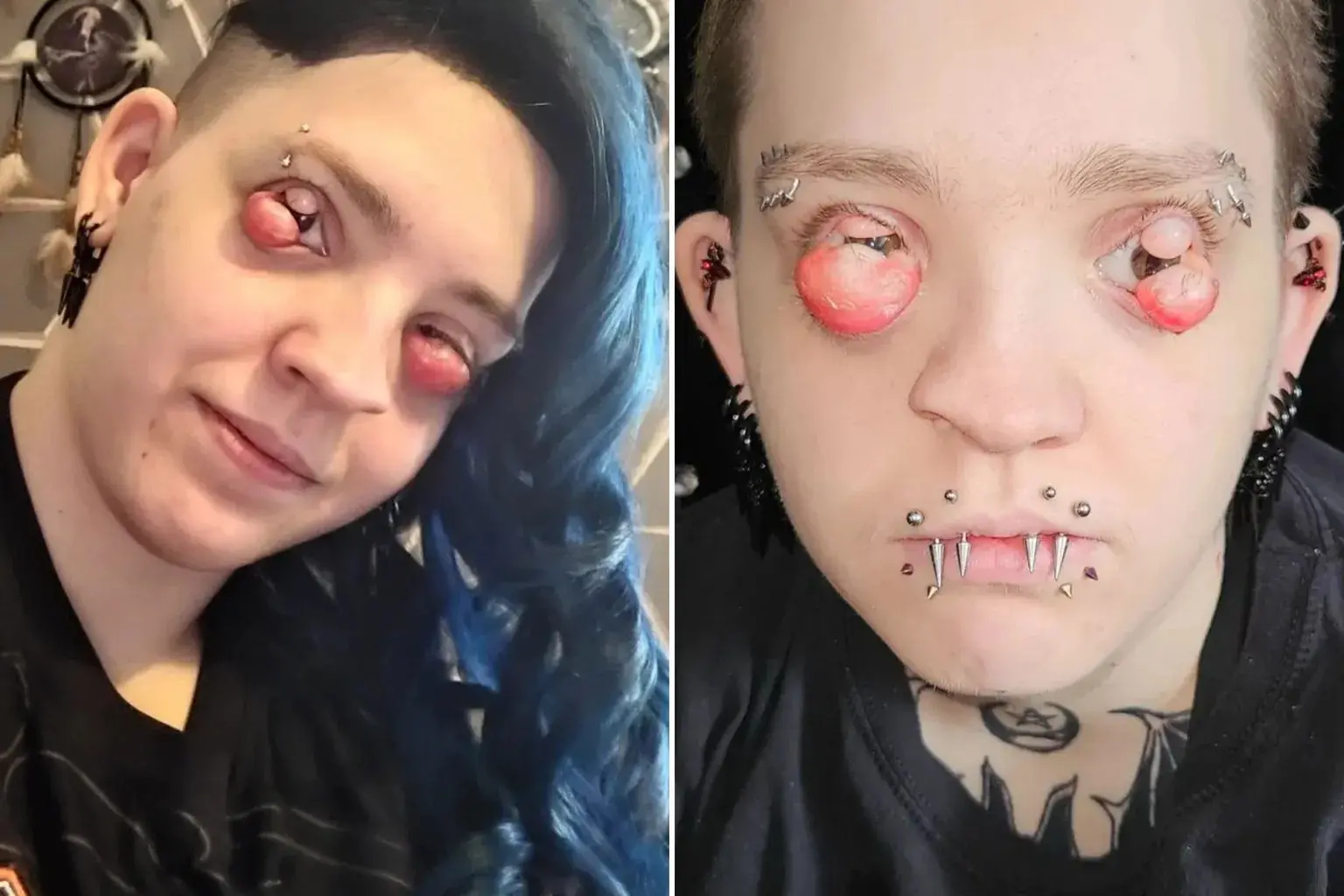 Mulher perde parte da visão após doença raro nos olhos (Foto: Reprodução/Redes sociais)