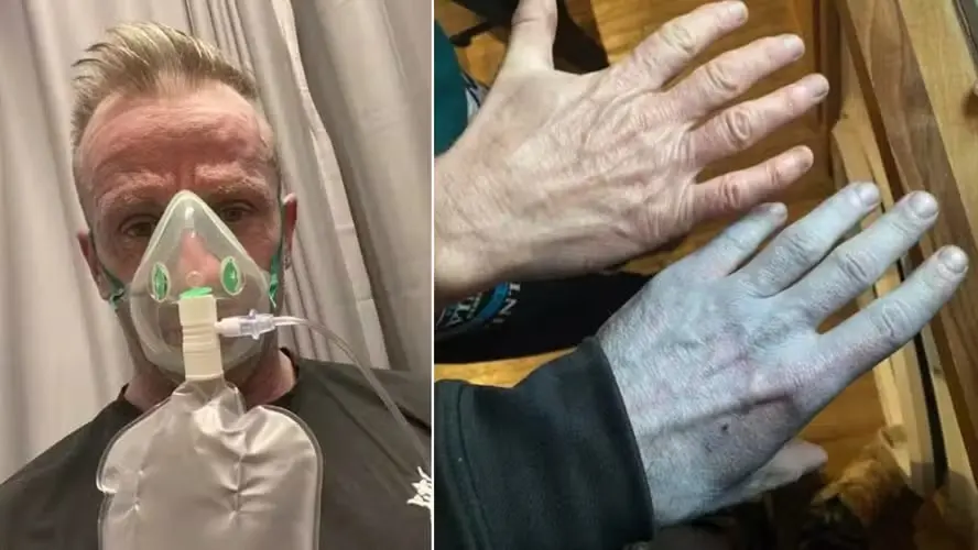 O britânico Tommy Lynch levou um susto ao acordar com partes do corpo azuladas após dormir com um edredom novo. Foto: Divulgação.