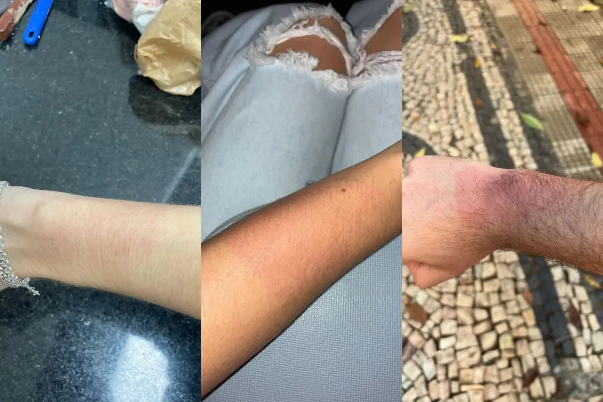 Show de Luan Santana termina com queimaduras em fãs após líquido vazar de pulseiras