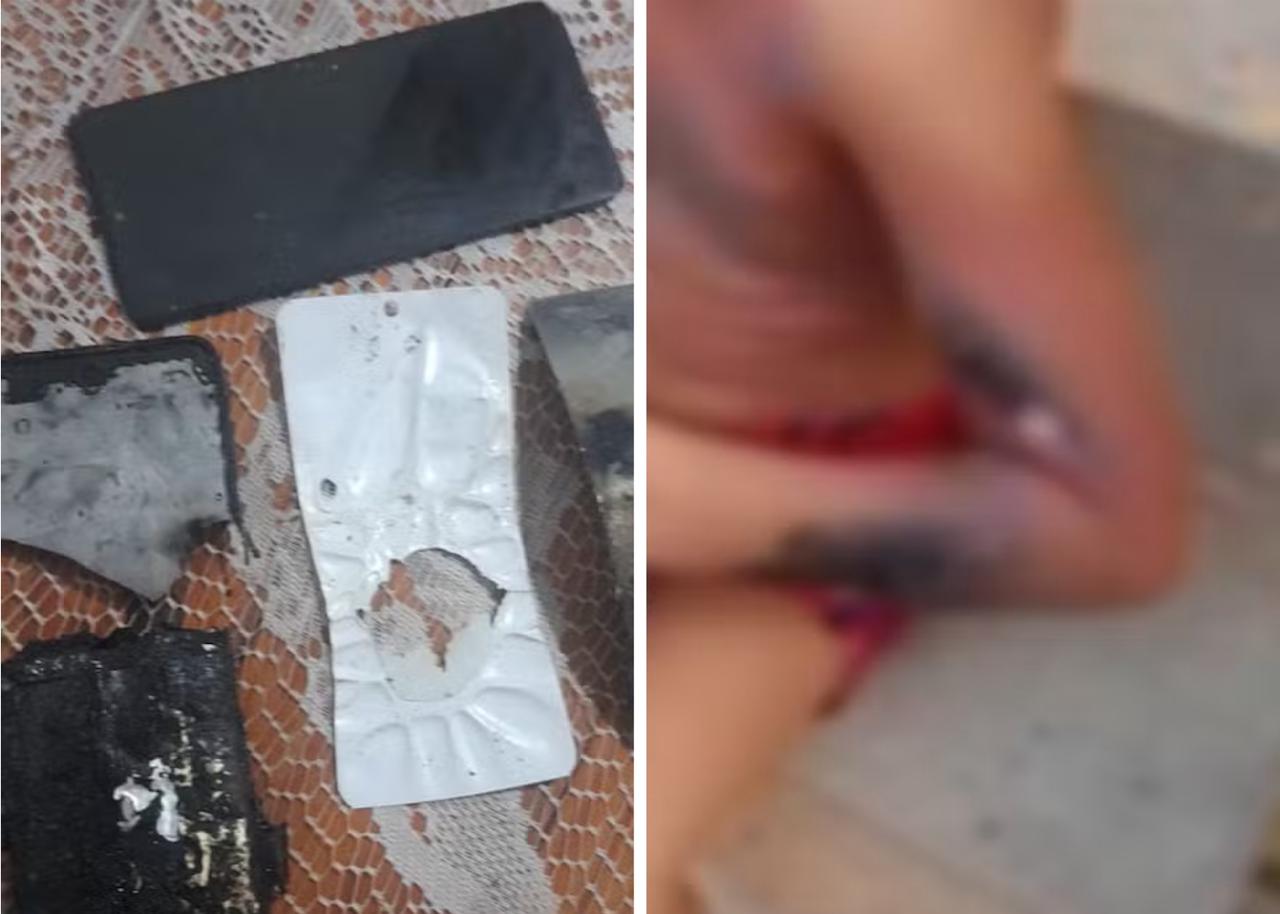 Criança fica gravemente ferida após celular explodir; saiba o que ocasionou a explosão