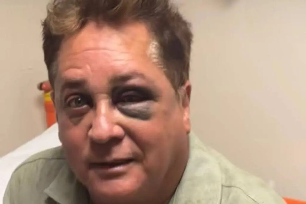 Leonardo apareceu com olho roxo. Foto: Reprodução / Redes Sociais.