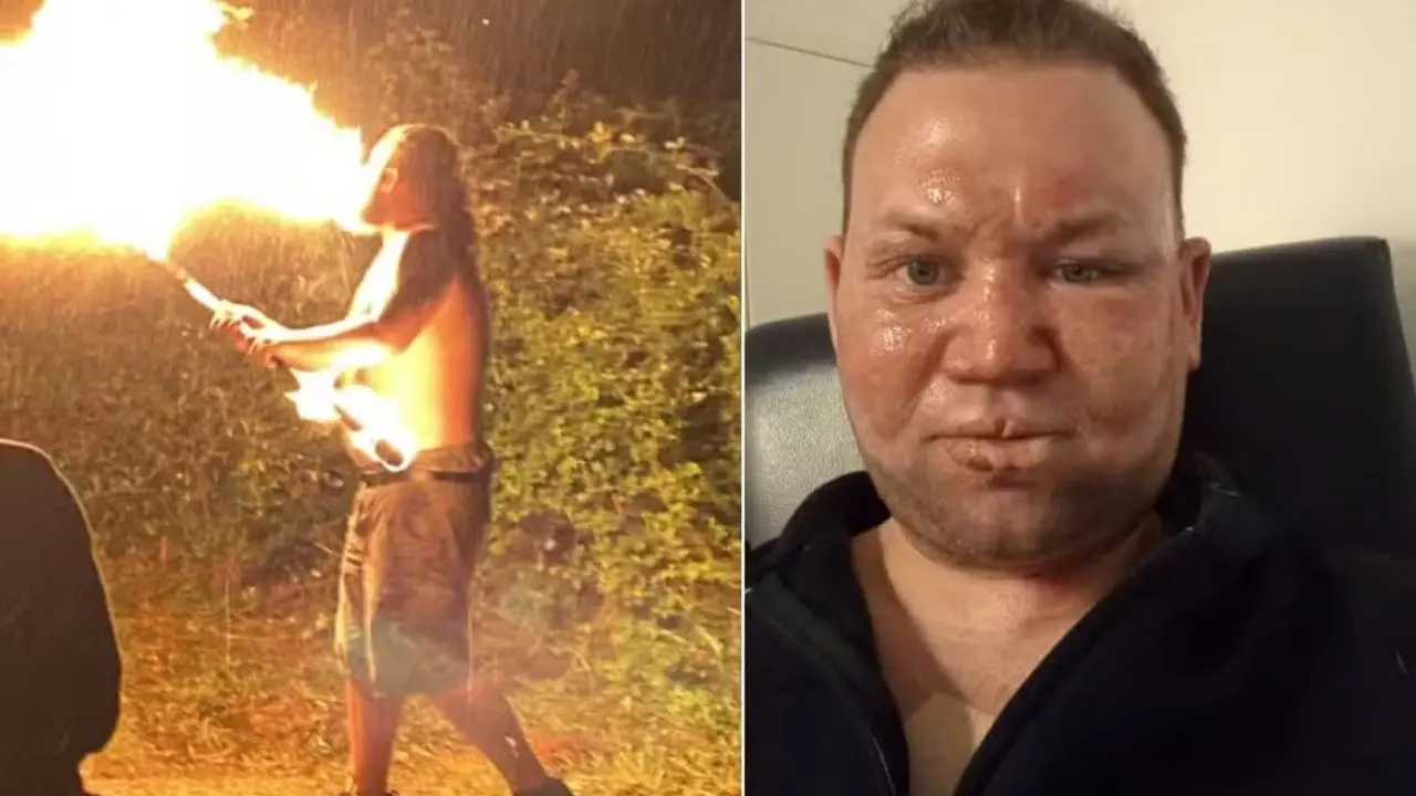 Cuspidor de fogo amador sofre acidente e acaba com o rosto queimado  (Foto: Reprodução)
