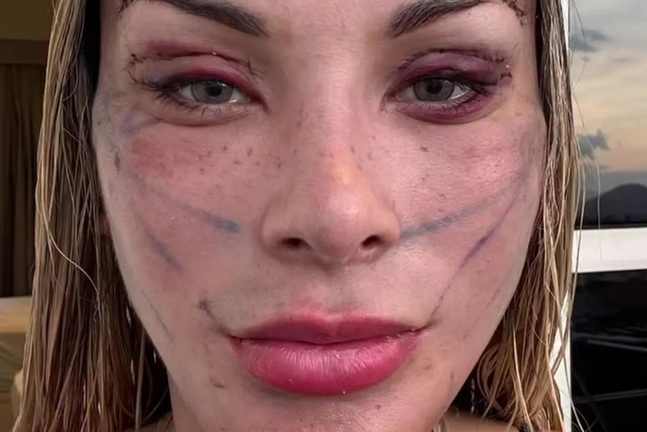 Andressa Urach pós-operatório || Reprodução: Redes Sociais 