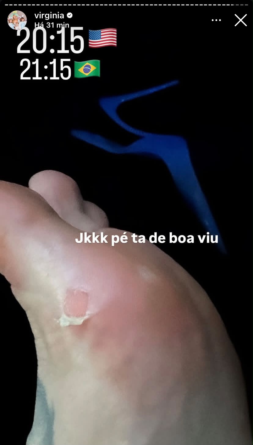 Virginia exibe hematoma no pé || Reprodução: Redes Sociais 