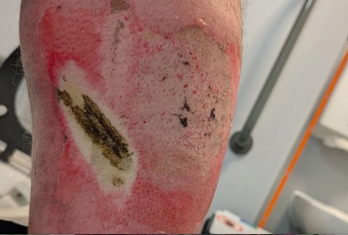 Um homem de 40 anos sofreu queimaduras graves depois que uma bateria de vape explodiu no bolso de sua calça. Divulgação