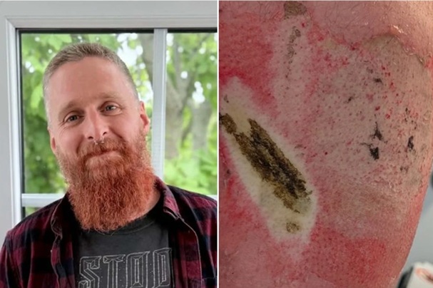 Um homem de 40 anos sofreu queimaduras graves depois que uma bateria de vape explodiu no bolso de sua calça. Divulgação
