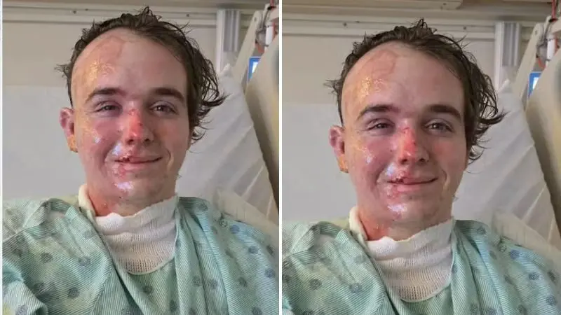 Jovem de 20 anos sofreu queimaduras graves; suspeito foi preso e responde por agressão com lesões graves  - Foto: Reprodução/GoFundMe